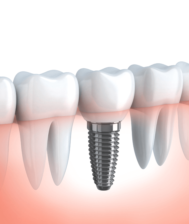 implant dentar balti 2