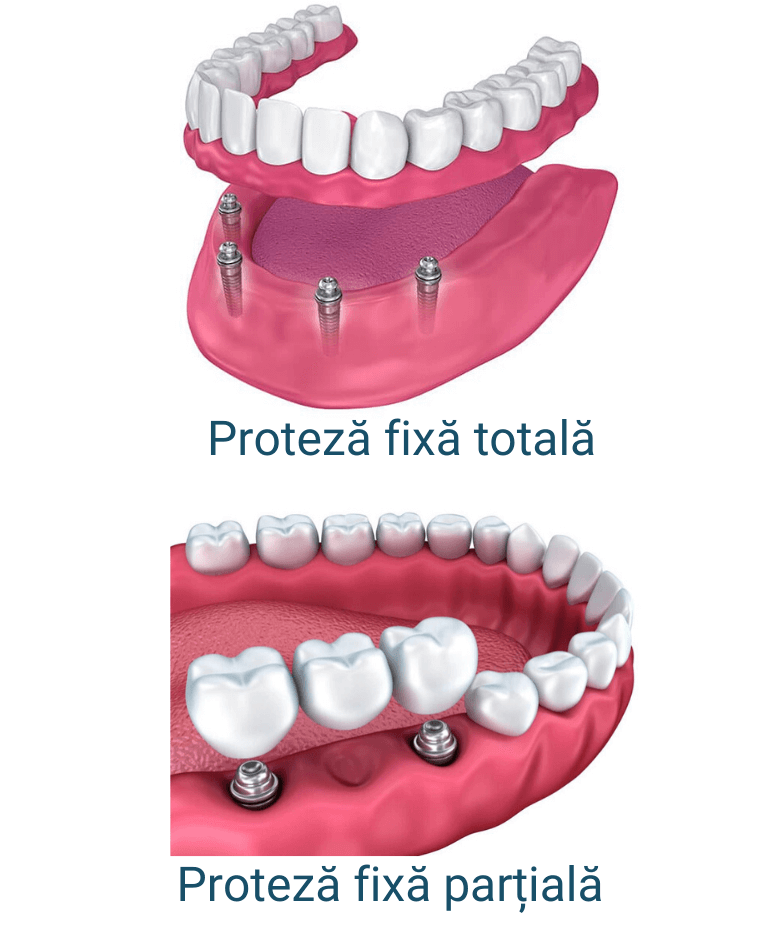 proteze dentare balti (1)